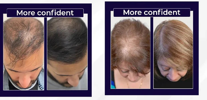 FEG Hair Growth Spray Plus Derma Roller, Suitable For Both Men and Women